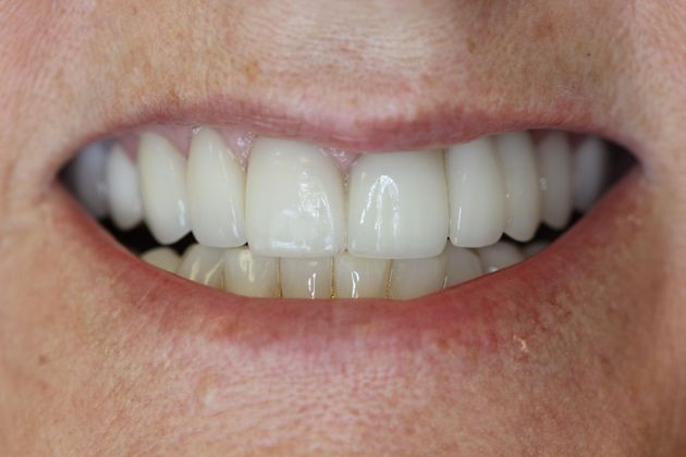 Close-up of smile after dental crown treatment in Oviedo FL at Alafaya Family Dentistry