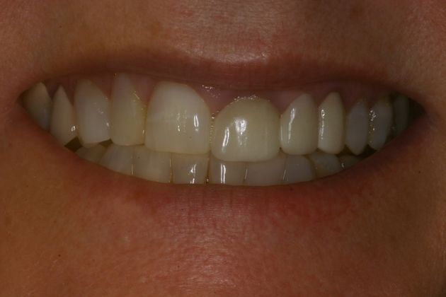 Close-up of before image of dental crown treatment in Oviedo, FL at Alafaya Family Dentistry