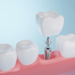 Dental Implants Available in Oviedo at Alafaya Family Dentistry